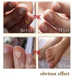 Chinese medicine - nail repair for onychomycosis - nail fungus - 10 mlTreatment