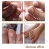 Chinese medicine - nail repair for onychomycosis - nail fungus - 10 mlTreatment