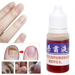 Chinese medicine - nail repair for onychomycosis - nail fungus - 10 mlTreatment
