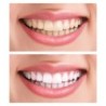 Silicone cosmetic denture - upper / lower bracesTeeth Whitening