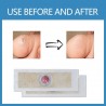 Foot corn / warts removal plasters - 12 piecesFeet